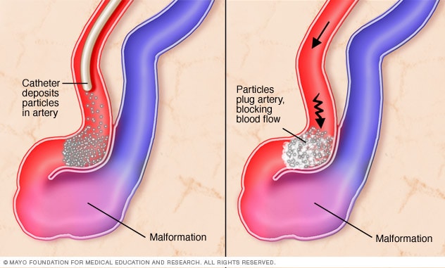 Primer plano de la embolización endovascular