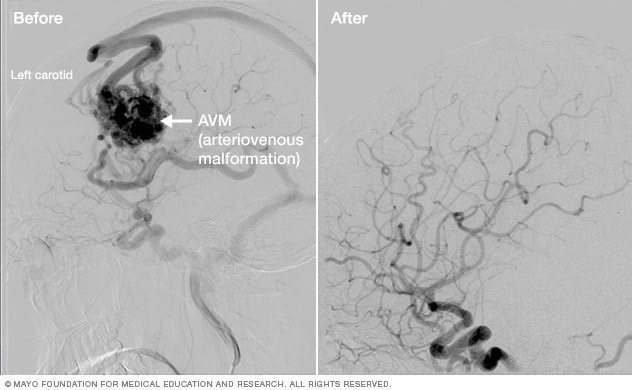 Resultados del tratamiento de malformaciones arteriovenosas cerebrales