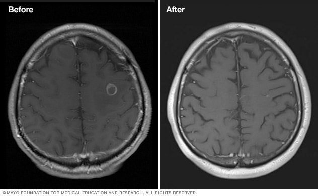 Tumor cerebral antes y después del tratamiento