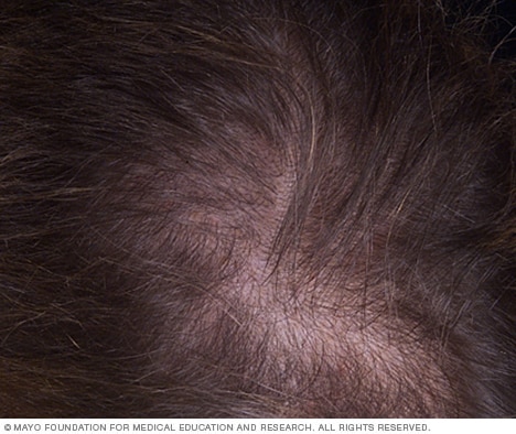 Women tend to lose hair along the part.