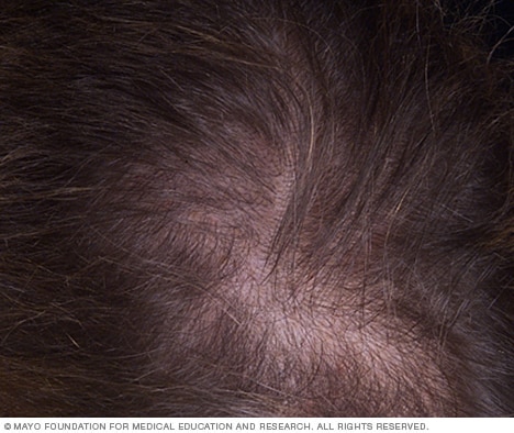 Hair loss - Symptoms and causes - Mayo Clinic