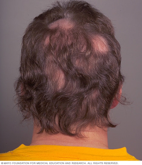 La pérdida del cabello irregular (alopecia areata) a veces va precedida de picazón o dolor en el cuero cabelludo.
