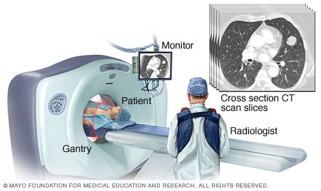 Lung cancer - Mayo Clinic