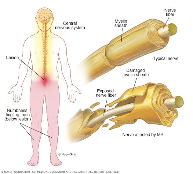 Mononucleosis - Symptoms & causes - Mayo Clinic