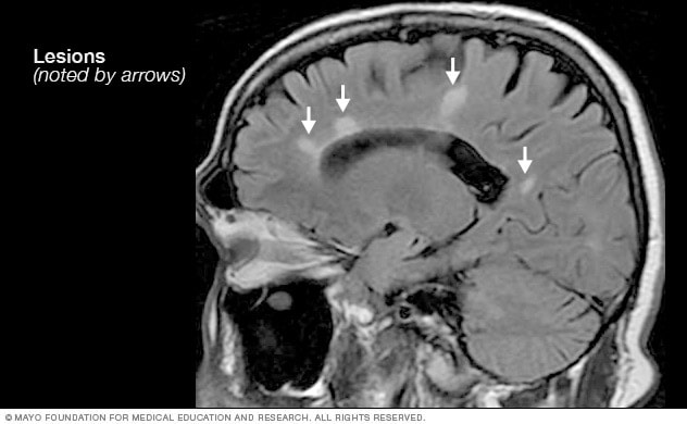 ms mri brain scan results