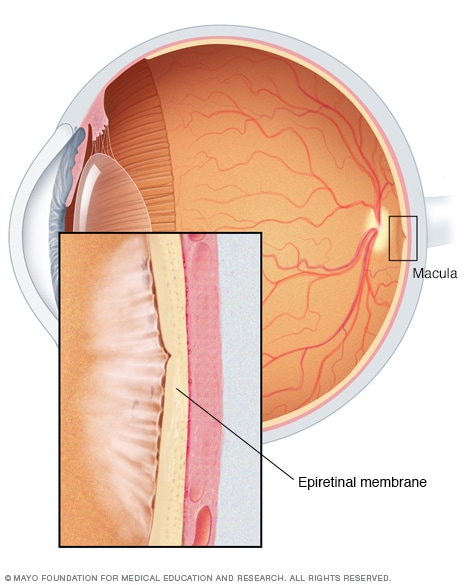 Illustration of epiretinal membrane