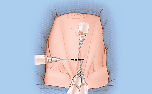 Image of locally anesthetized site
