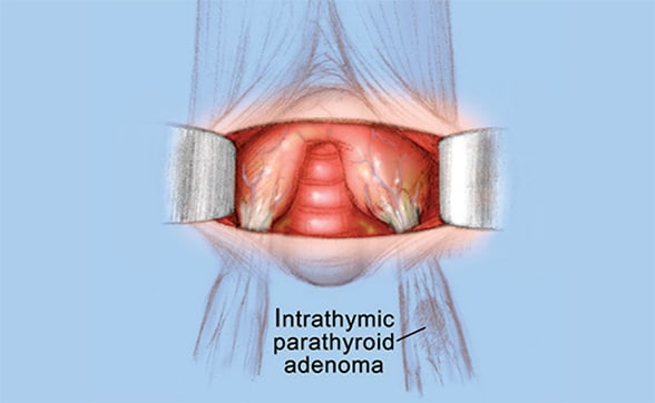 Image of incision revealing lower poles of thyroid lobes