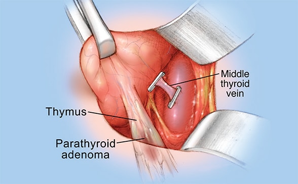 Image of elevated lobe revealing parathyroid adenoma