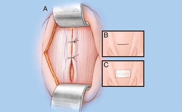 Image of closed incision