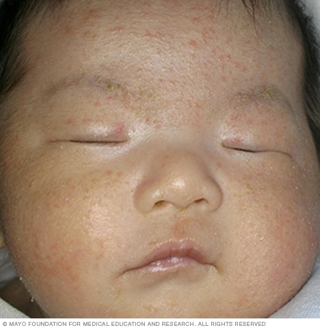 Imagen de acné en bebés