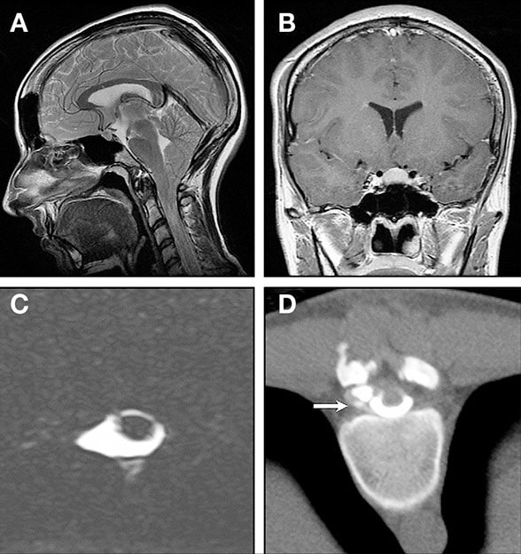 Images of a woman with orthostatic headaches and pain in the posterior neck and shoulder muscles