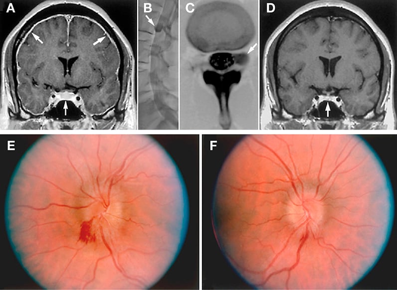 Images of man with orthostatic headaches, dizziness, nausea, and bowel and bladder incontinence