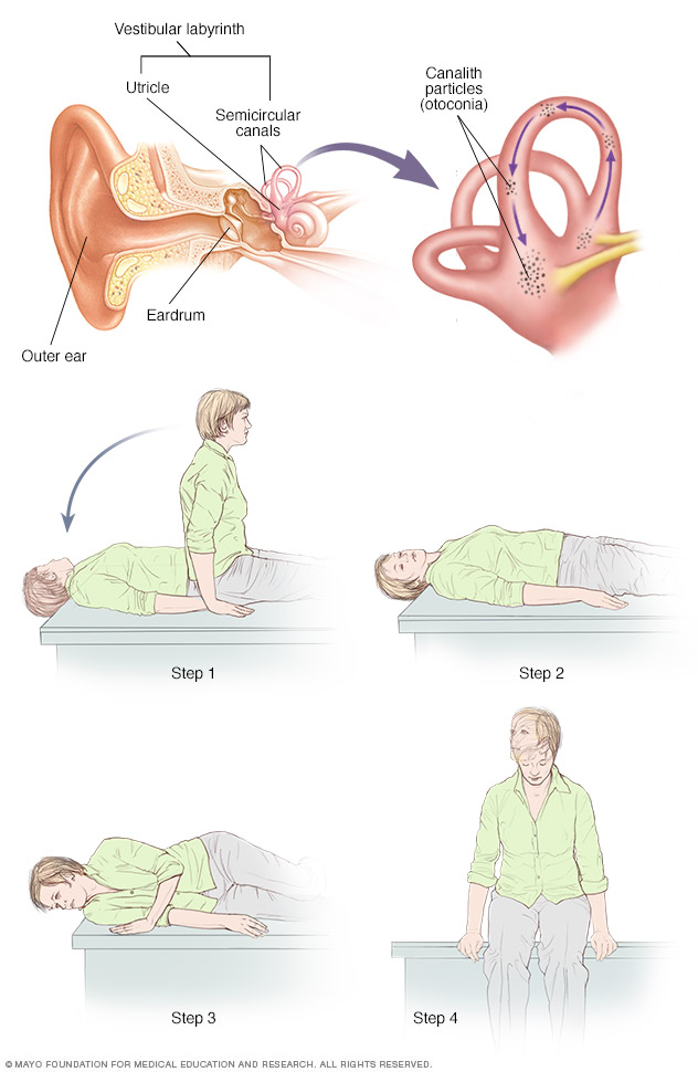 Vertigo Exercise Chart