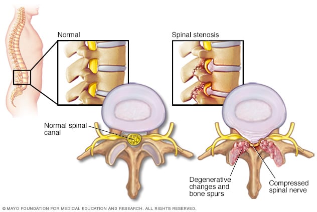 De qué manera la estenosis del conducto vertebral puede comprimir los nervios raquídeos.