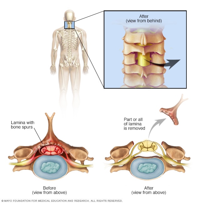 Laminectomía cervical