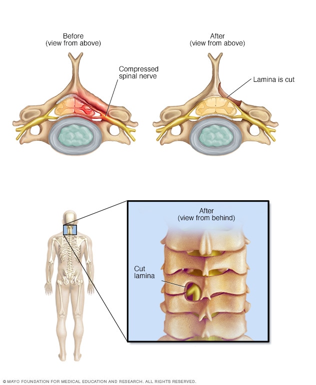 Spinal stenosis - Symptoms and causes - Mayo Clinic