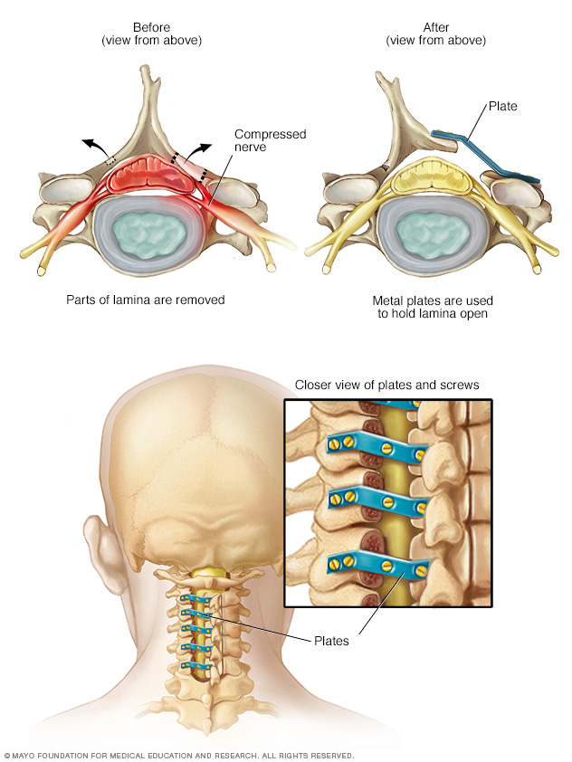 Cervical Laminoplasty 