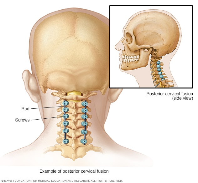 Ilustración que muestra los materiales utilizados para unir la columna desde la parte posterior del cuello.