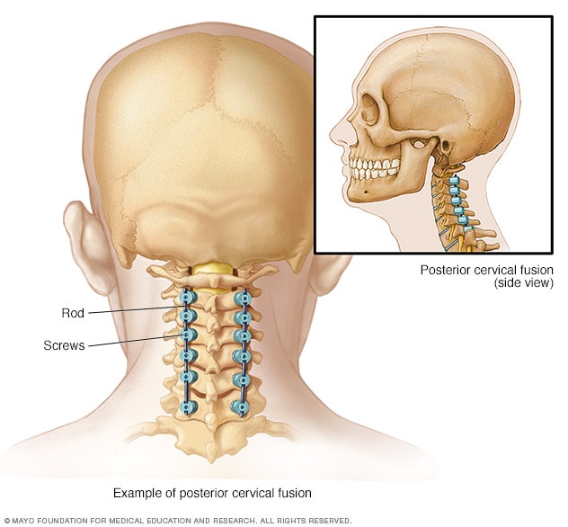 Spinal fusion - Mayo Clinic