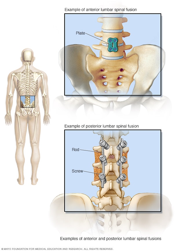 用于融合腰椎的金属硬件的图示。