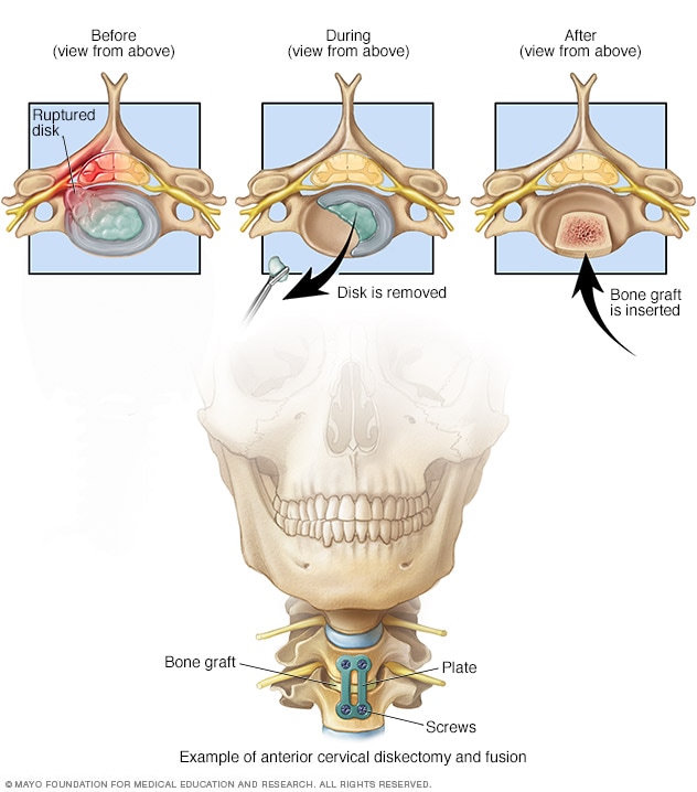 Ilustración que muestra las piezas metálicas utilizadas para fusionar la columna desde la parte delantera del cuello.