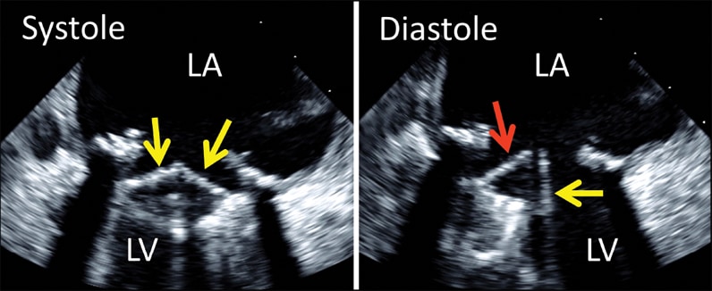 2-D image of transesophageal echocardiogram of bileaflet mechanical mitral valve prosthesis