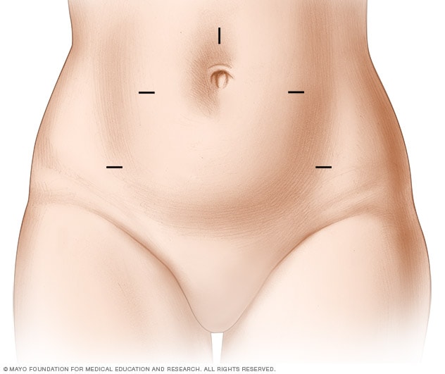 laparoscopic hysterectomy before and after