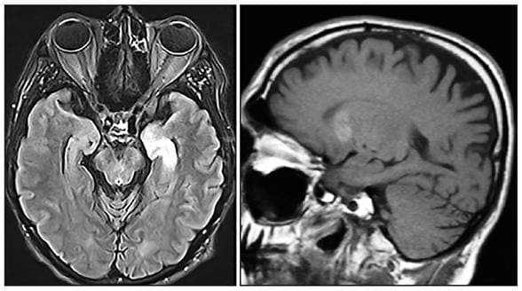 MRI showing abnormalities in temporal lobe and basal ganglia