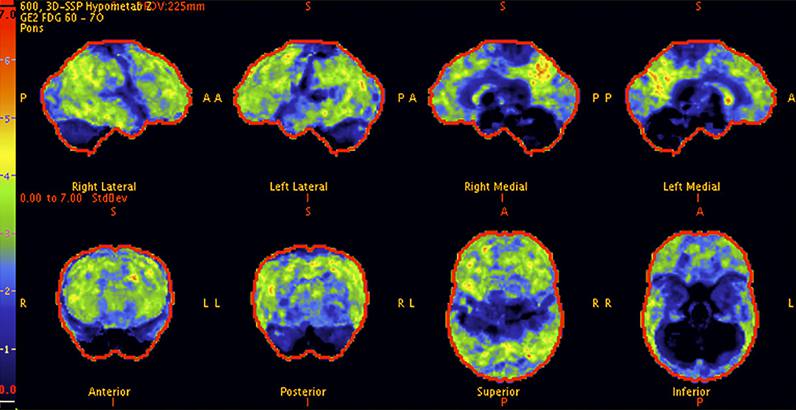 Prominent hypometabolism with pattern suggestive of Alzheimer's disease