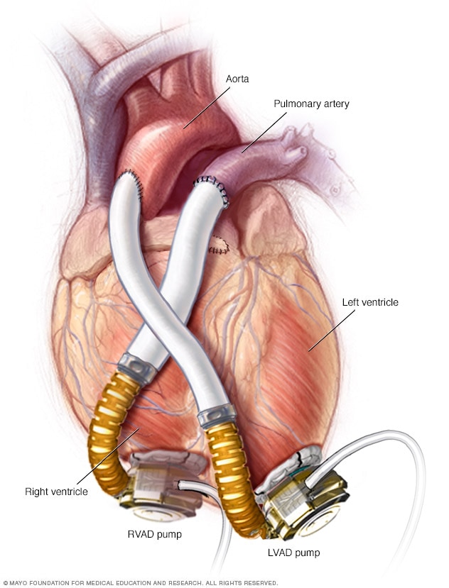 VAD and IABP Market: the Biventricular assist device (BIVAD)