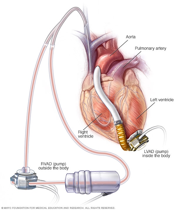 Right and left ventricular assist device