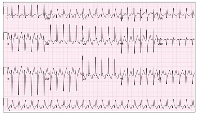 Electrocardiogram of posterior fascicular ventricular tachycardia