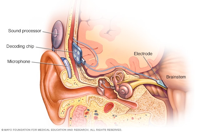 Implante auditivo de tronco encefálico