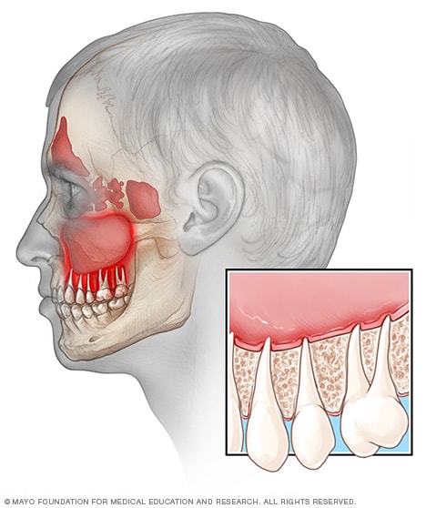 Sinusitis and tooth pain - Mayo Clinic e nose block diagram 