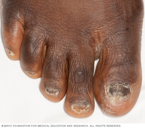 herpes rash on black skin