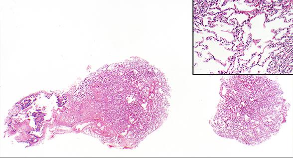 Lung allograft showing well-expanded alveoli