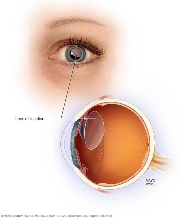 Luxación del cristalino del ojo