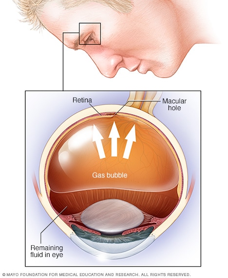 Illustration depicting pneumatic retinopexy