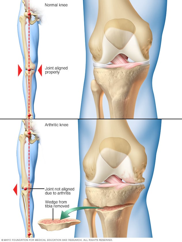 tratament de osteoscleroză articulară