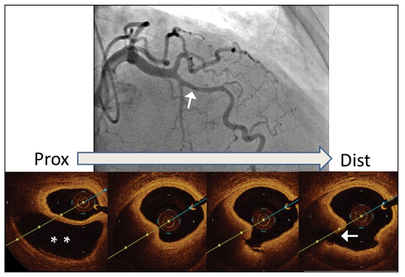 Coronary angiogram and OCT of intramural hematoma