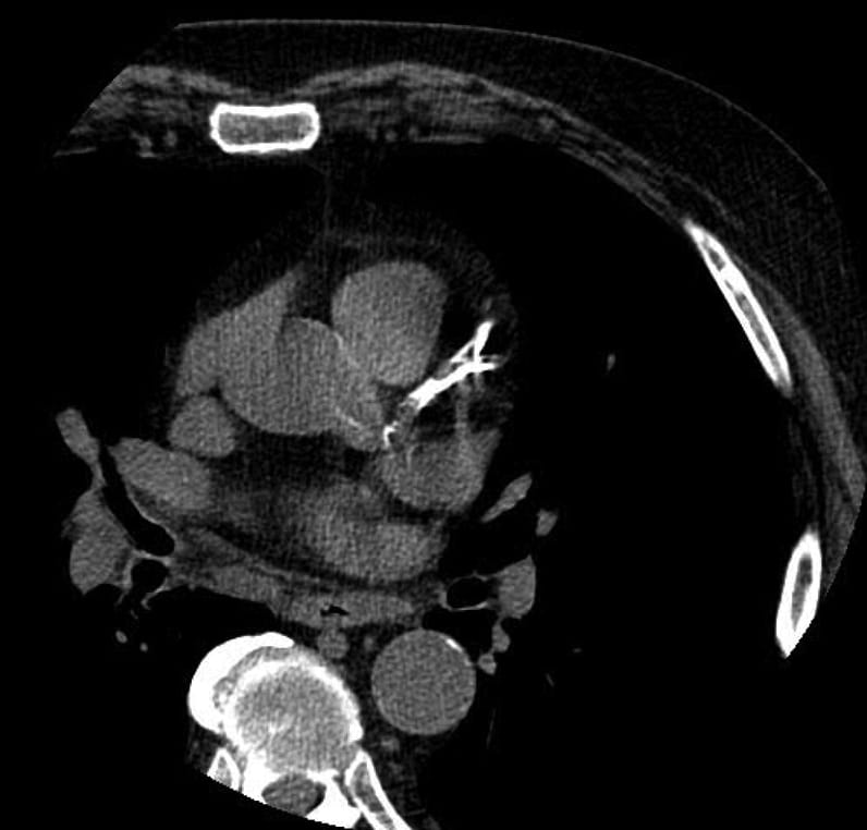 患者的 CT 扫描总 CACS 为 4,410 个 Agatston 单位