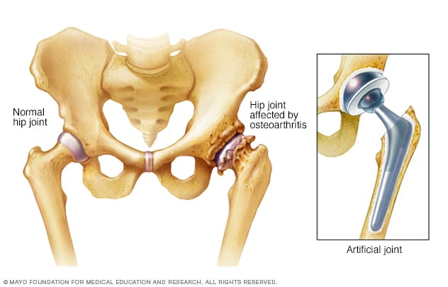 Illustration of hip affected by osteoarthritis before and after hip replacement
