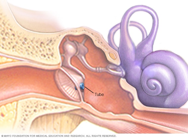 Image result for ear tube placement surgery