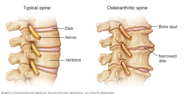 Boala articulației coloanei vertebrale