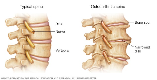 Illustration showing osteoarthritis of the spine<br /><br />
