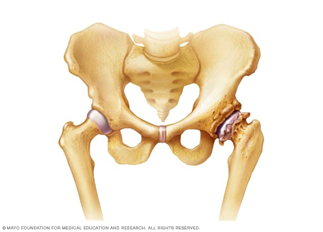 Illustration showing osteoarthritis of the hip 
