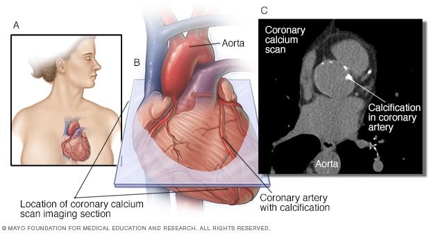 Escaneo de calcio coronario