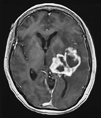 MRI showing large, deep glioblastoma