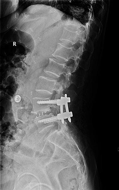 Insertion of percutaneous pedicle screws